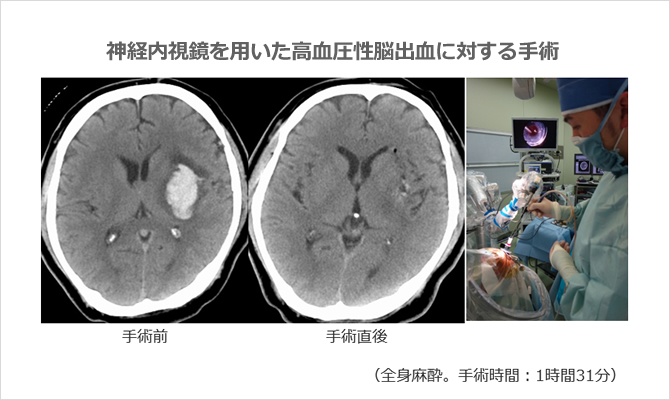 神経内視鏡を用いた高血圧性脳出血に対する手術