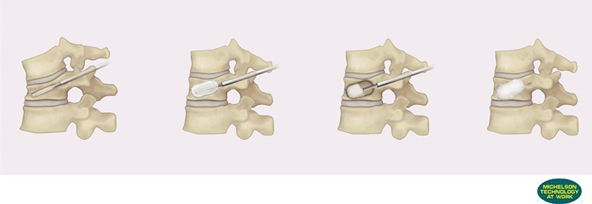 骨セメントによる経皮的バルーン椎体形成術